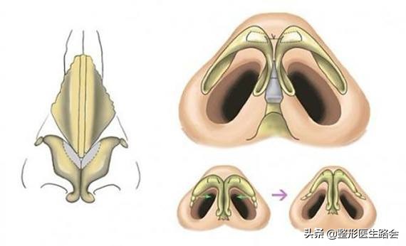 鼻子是怎么垫高的,鼻子垫高点更完美了