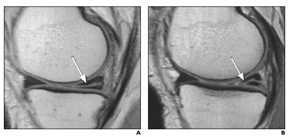 磁共振疑似半月板损伤什么意思,磁共振误诊半月板撕裂