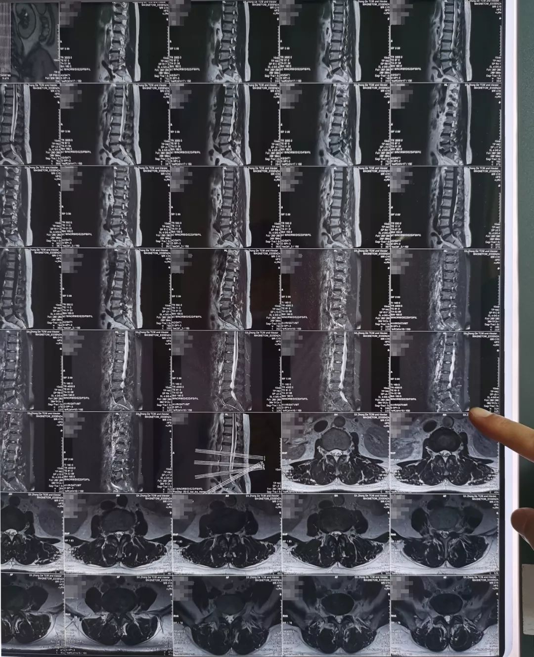 腰椎间盘突出并腰椎管狭窄怎么办,腰椎管狭窄腰椎间盘突出怎么治