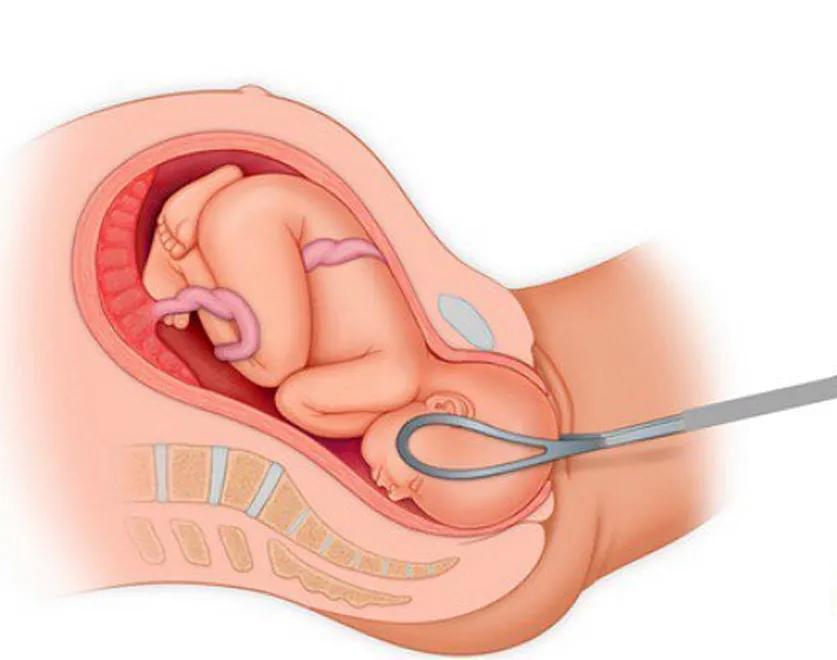 产钳夹出孩子,产钳夹过的孩子的图片