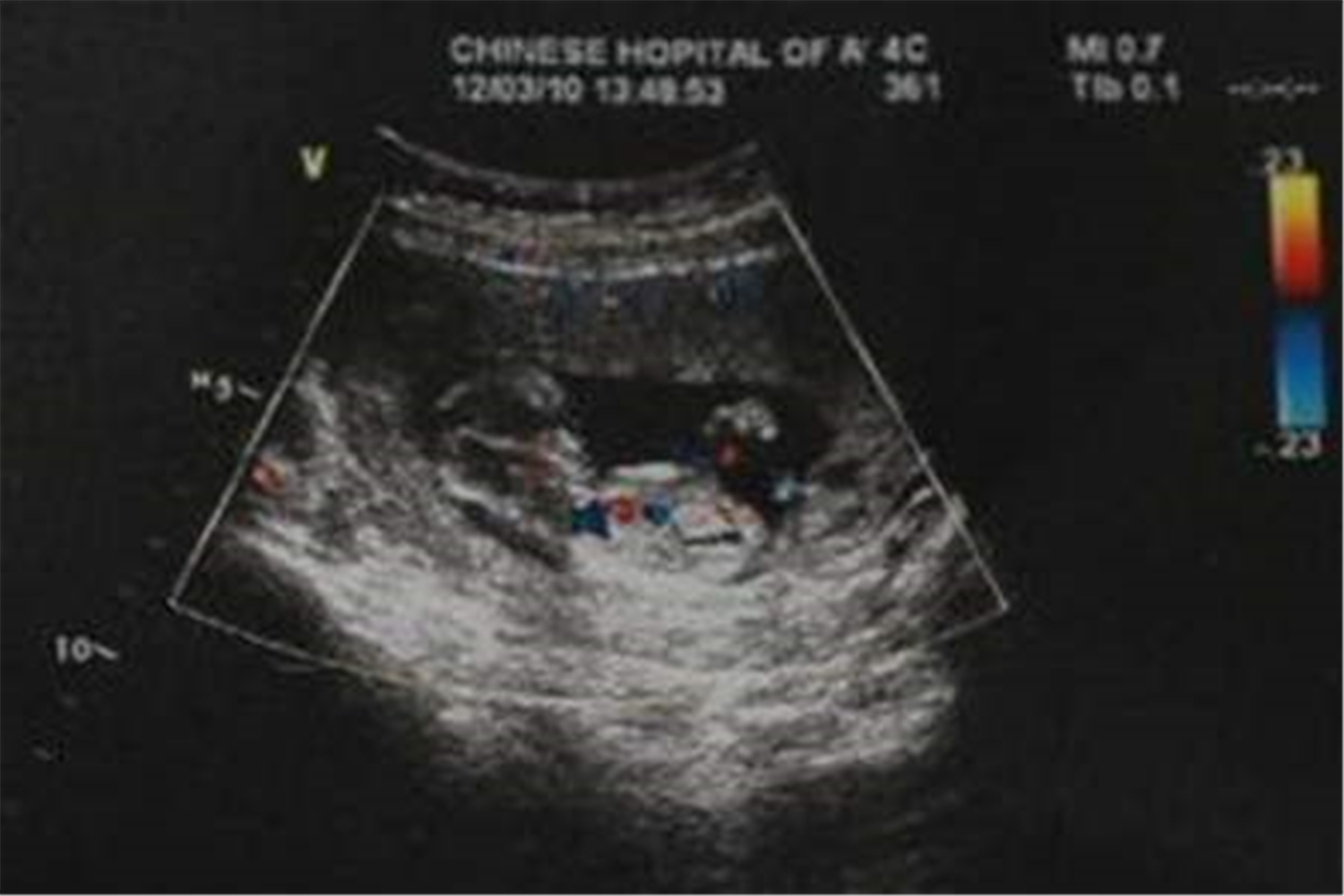 胎宝宝首次排畸检查nt的意义,nt筛查的是什么