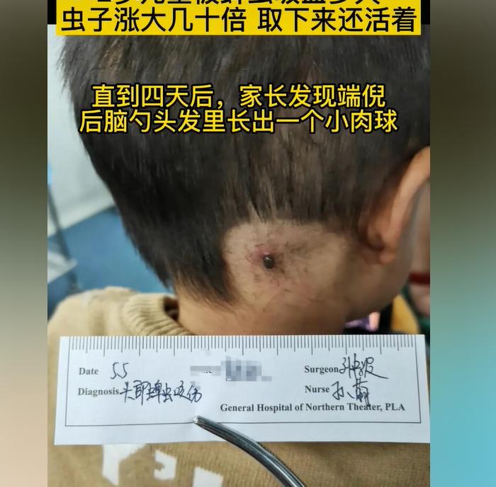 小朋友被蜱虫咬了怎么办,小孩遭蜱虫咬爸爸抱小孩进医院