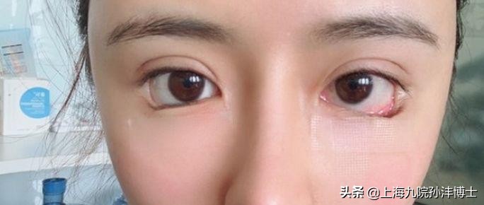 孙沣眼修复有成功案例么,眼修复能找原来医生修复吗