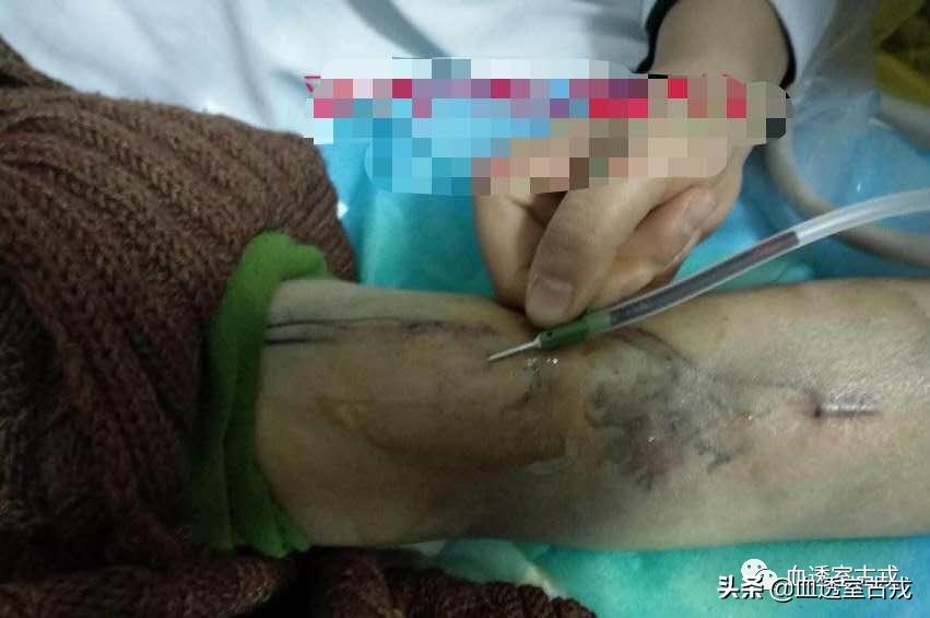 内瘘穿刺血肿的处理方式,皮下血肿穿刺抽吸后又出怎么办