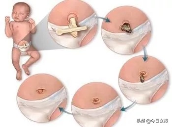 脐带剪断后孩子的肚脐怎么办,婴儿脐带断了怎么办