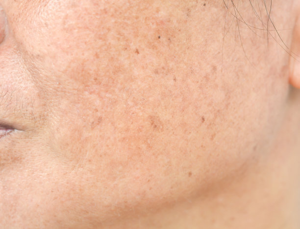 衰老型毛孔粗大最省钱有效的方法,衰老型毛孔粗大皮肤怎么改善