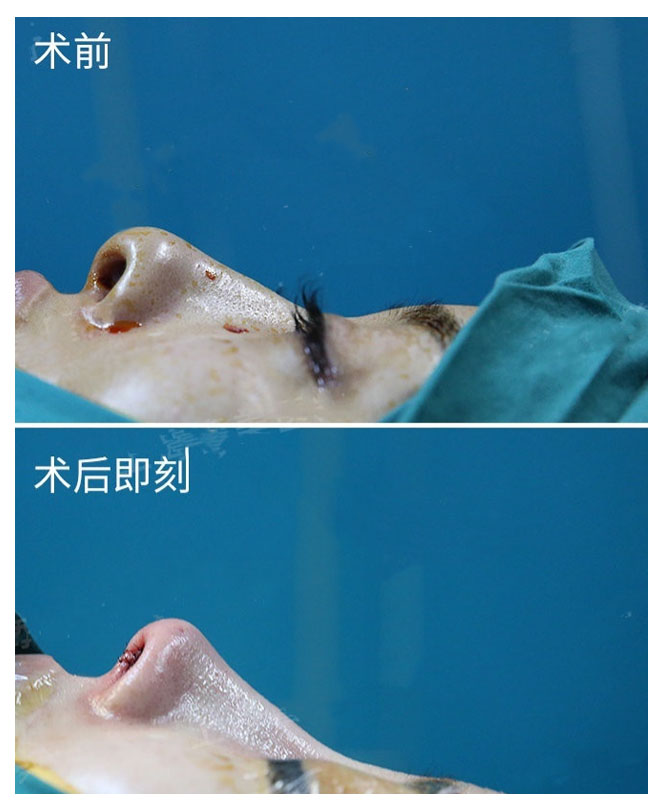 鼻子太塌改善的小窍门,鼻子太塌怎么办整形