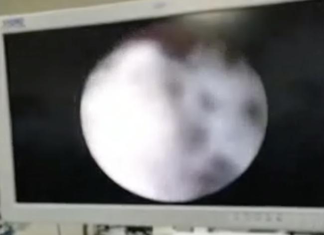 儿童萌芽性出血,2岁女童间断性出血