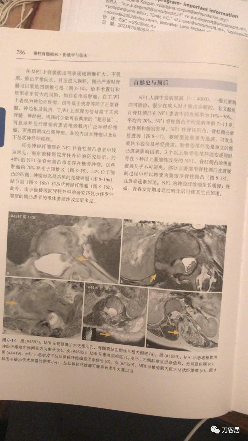 我的门诊病历：家族性神经纤维瘤病性脊柱侧凸