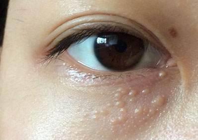 腋下脖子上长肉粒用什么药膏,腋下脖子上长小肉粒吃啥药