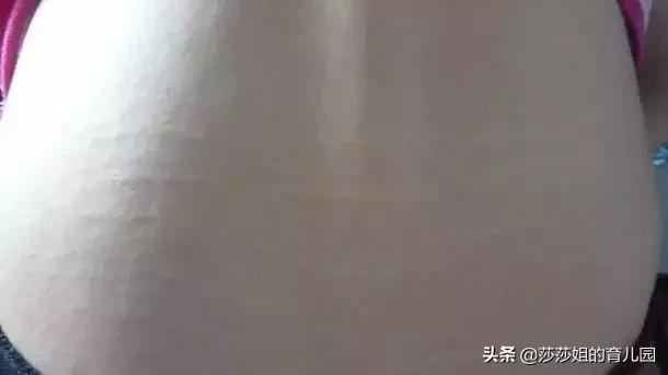 肾虚纹真的代表肾虚吗,肾虚纹是什么原因造成的