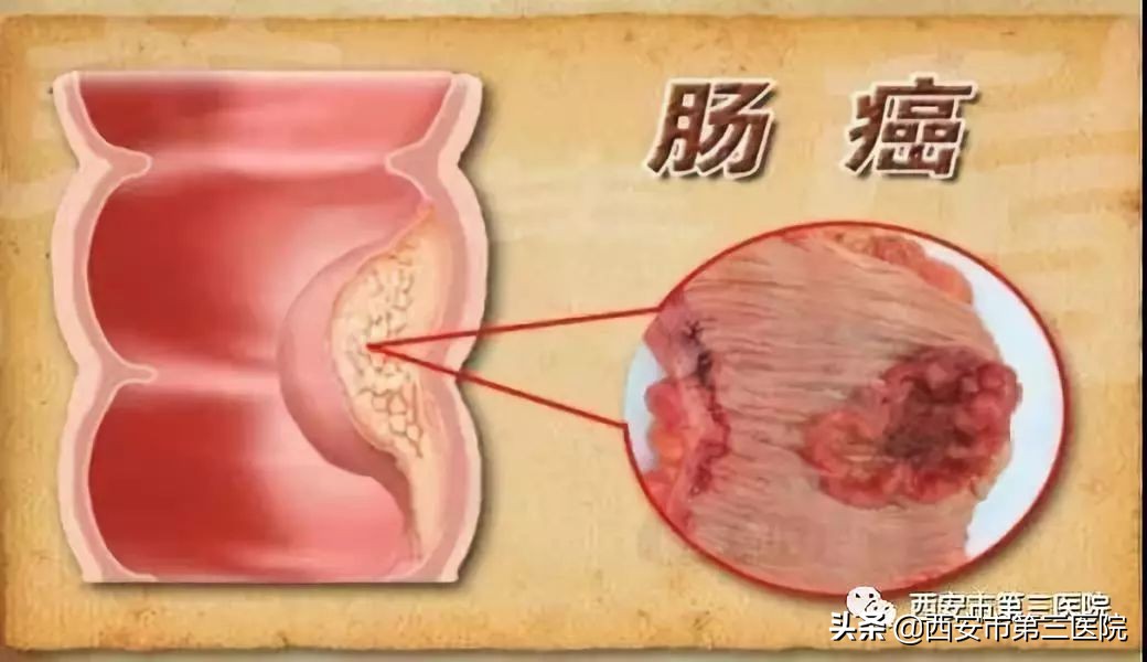专家医生讲胆囊息肉,息肉是否越切长得越快
