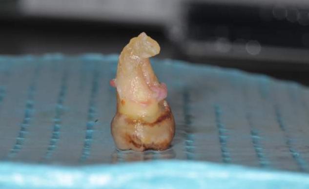 拔智齿断的一点在里面没有关系吗,拔智齿断了牙根留在里面如何处理