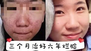 背上长痘千万别用青草药！谭中医为你提供一招妙方