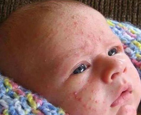 宝宝湿疹反反复复预防护理有技巧,3个月宝宝湿疹反反复复怎么根除