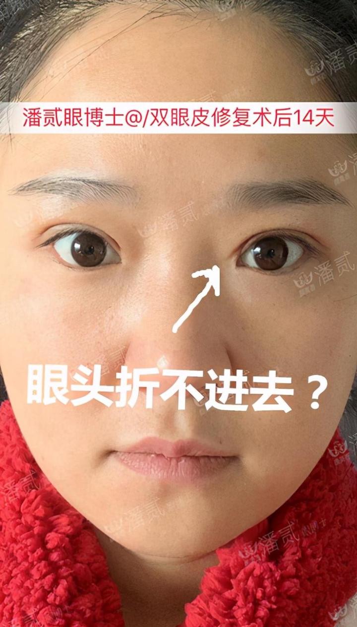 双眼皮修复要对医生说实话吗,双眼皮失败可以修复的几率有多大