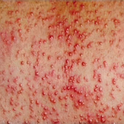 孩子老爱长痱子怎么办,儿童长痱子用什么药好