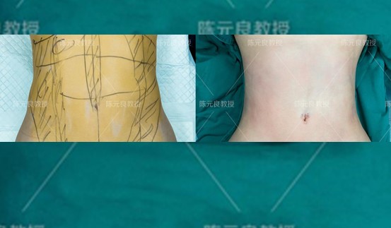 想吸脂减肥具体需要怎么做,想做个吸脂去哪家医院