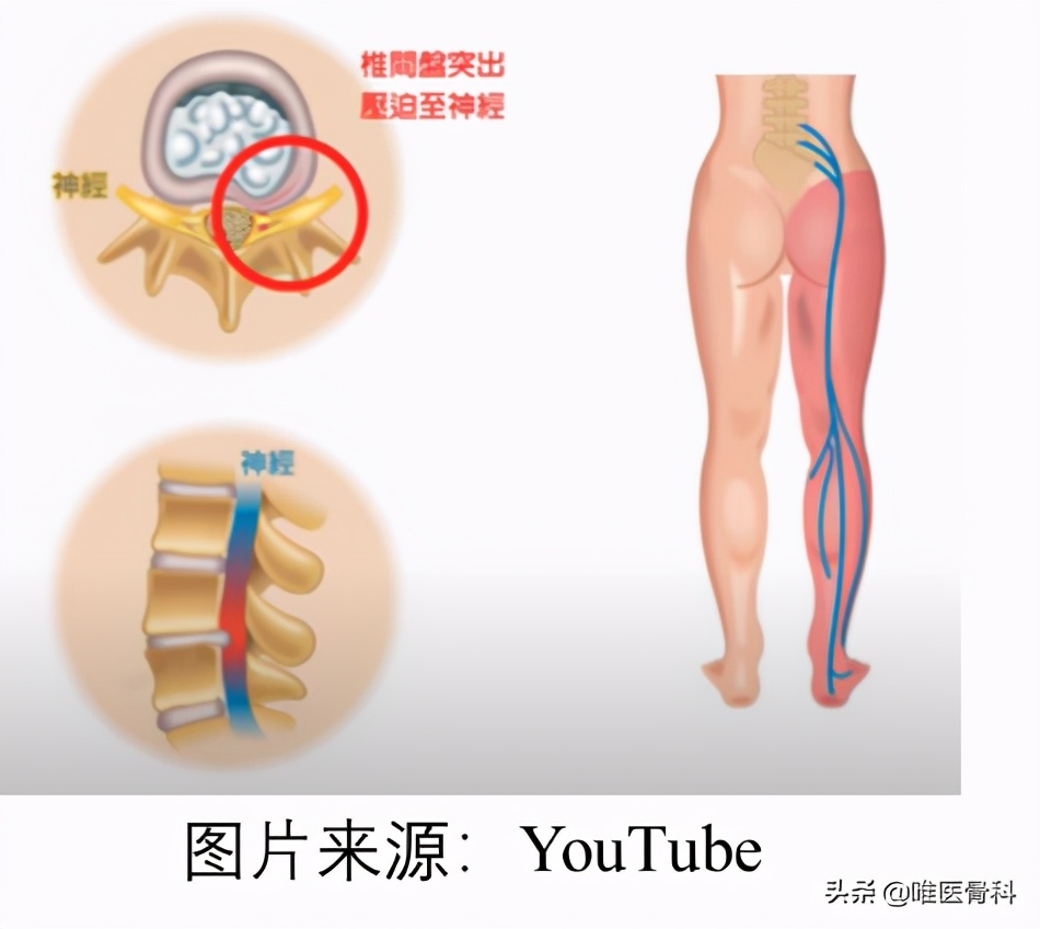 腰间盘膨出腿疼脚麻怎样治疗最好,腰间盘膨出腿麻腿疼怎么缓解