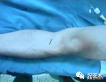 肩锁关节脱位手术后多久可以喝酒,肩锁关节脱位钢板内固定步骤记录