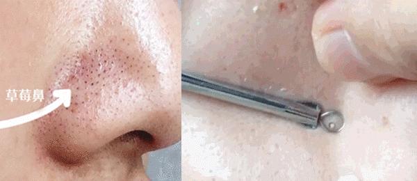 解决黑头的2种药,解决黑头的最好方法