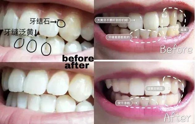 刷牙时一个小窍门彻底告别黄臭牙,刷牙的时候放点小苏打牙会变白吗