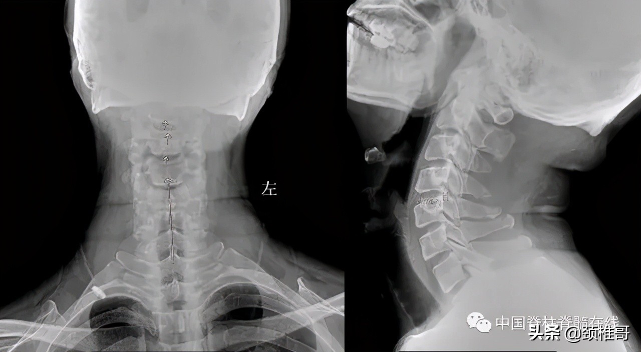 颈椎病的护理临床路径流程图,颈椎病的健康管理与康复指导
