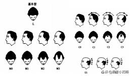 生理性脱发导致秃了怎么办,秃如其来脱发青年这样自救