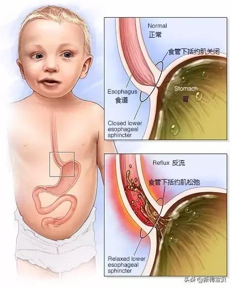 宝宝嗓子呼噜有痰小妙招,宝宝嗓子呼噜呼噜响是怎么回事
