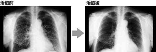 最新科研进展nk免疫细胞治疗癌症,抗癌药物组合物