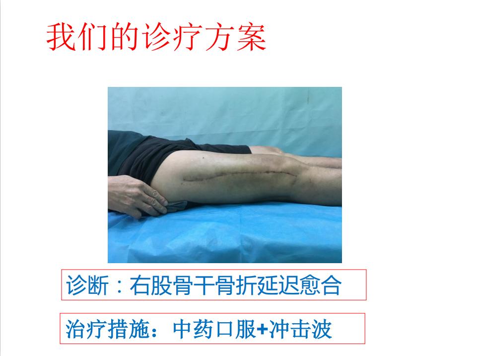 平乐骨科推拿教学,中医治疗骨折畸形愈合