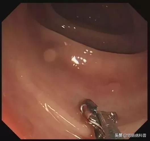 只要是肠息肉都要割掉吗,医生肠息肉切除后怎么处理伤口