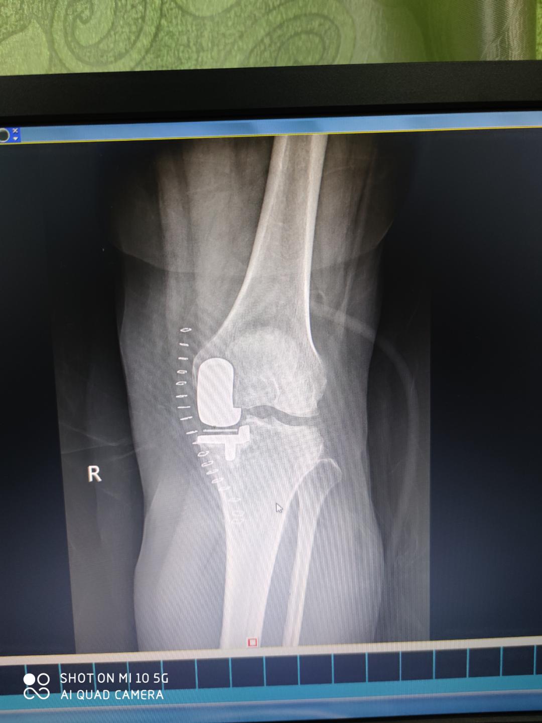 百色市人民医院关节外科开展膝关节单髁置换术，保膝技术再添“法宝”