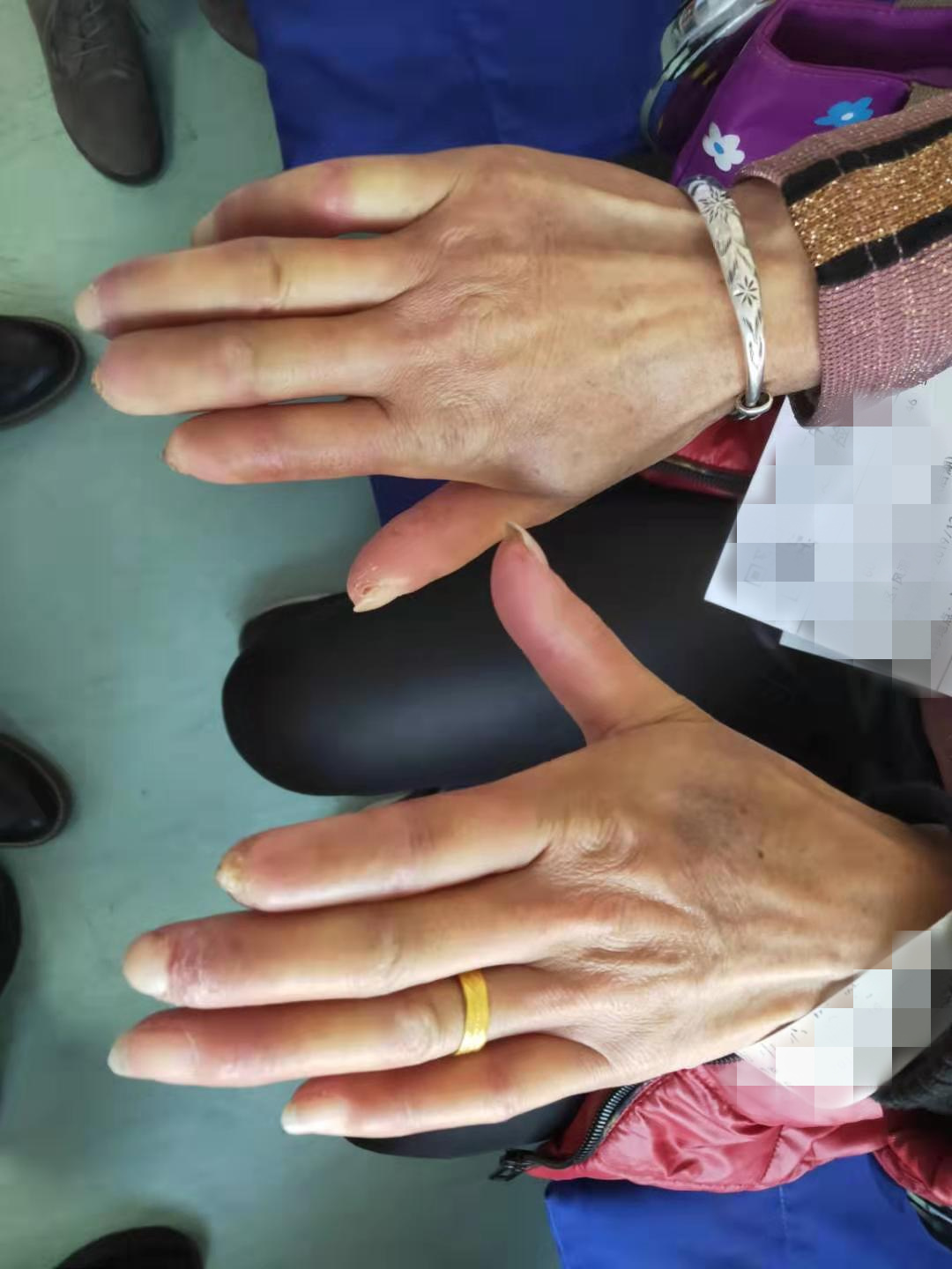 手指遇冷就变色误当冻疮3年后指尖坏死
