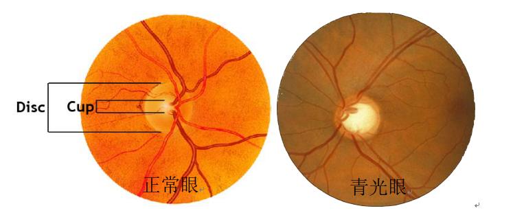 青光眼的定义及发病机制,诱发青光眼的一些因素