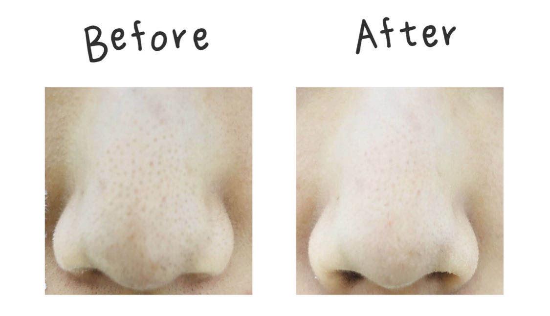 去黑头攻略：被黑头耽误的鼻子是该处理一下了