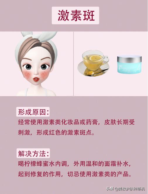 斑的种类及护理建议,斑点总去不掉先看看你是哪种斑