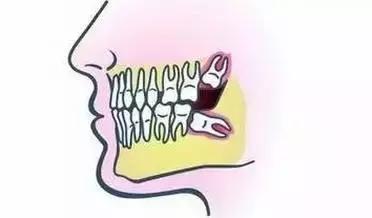 备孕前智齿一定要拔掉吗,正畸一定要拔掉智齿吗