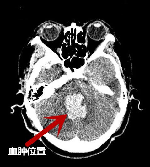 突发脑干出血机器人来救命