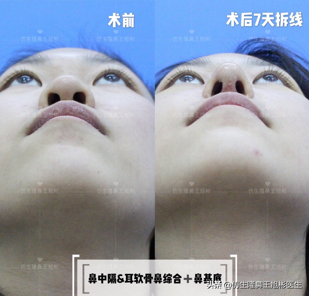 外切缩鼻翼的后遗症,外切鼻翼缩小会回弹吗