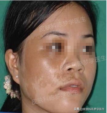 褐青色雀斑多久能治好,脸上起褐斑怎么治效果快