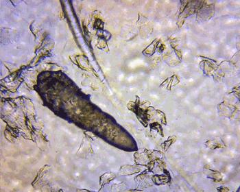 毛孔堵塞有黄色油脂,毛孔长黄色油脂粒