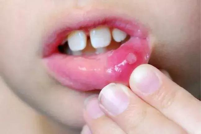 口腔溃疡怎么治好得快小偏方,口腔溃疡吃什么好得快小偏方