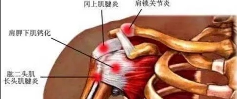 脚腱鞘炎一招搞定,腱鞘炎三个步骤轻松搞定