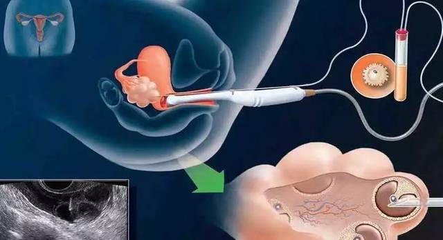 常见卵巢早衰的治疗方案,卵巢早衰能治好吗如何治卵巢早衰