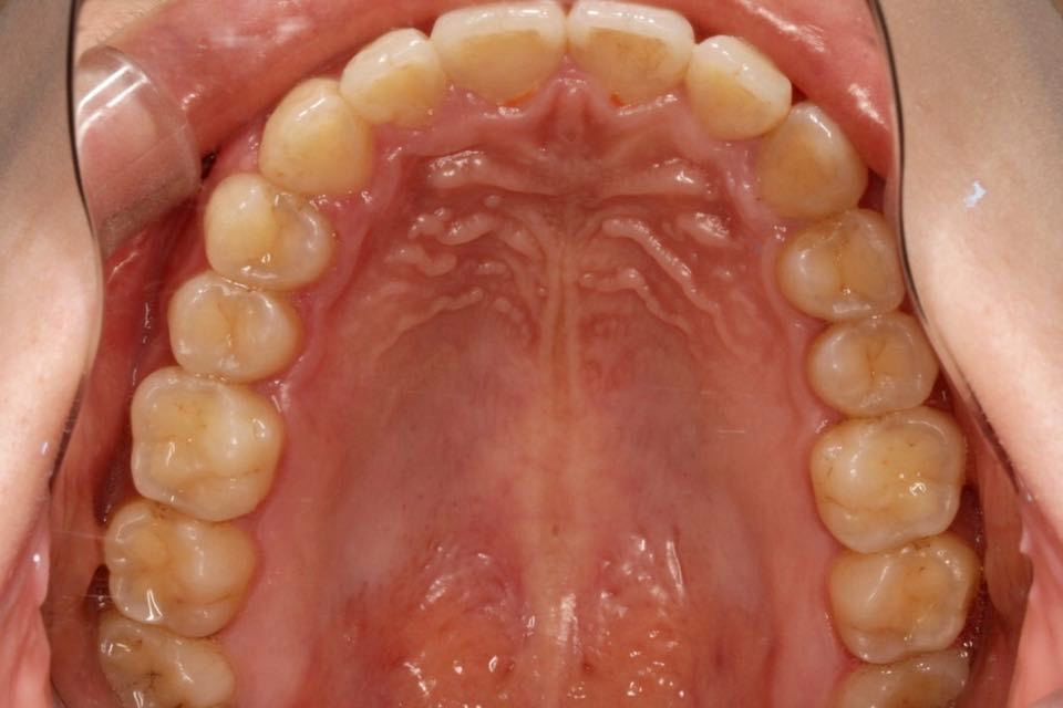 西安张军正畸医生如何,西安牙齿矫正案例