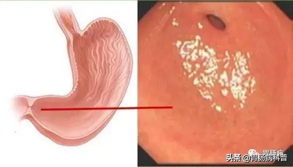 医生做胃镜检查时会看食道的吗,胃镜检查全过程视频消化内科检查