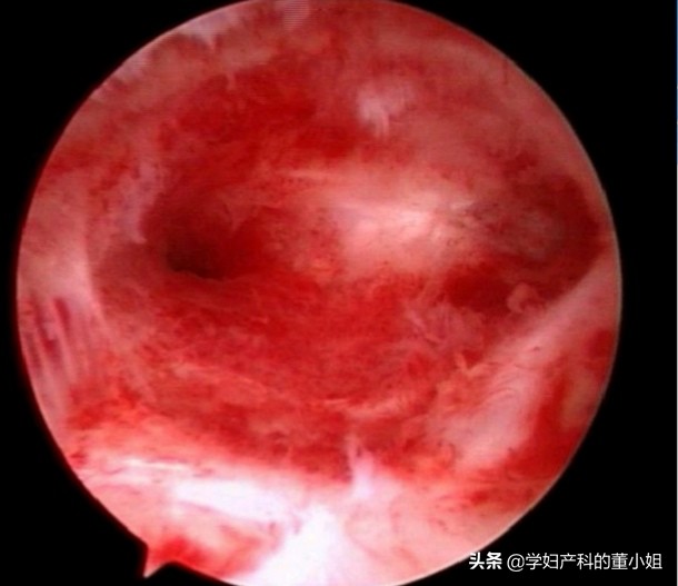 我怀孕了流产了,我怀孕了自己流掉了还需要清宫吗