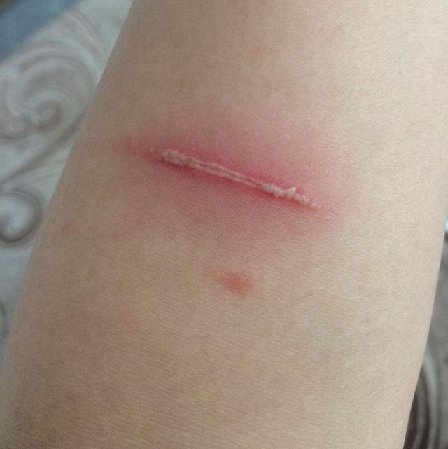 儿童简单外伤的处理方法,如何讲解儿童外伤处理小常识