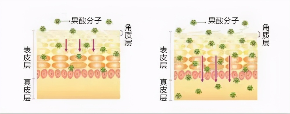 果酸水祛黑头闭口粉刺,做果酸换肤前要清理粉刺和黑头吗